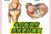 半月板损伤的治疗与恢复（如何有效地治疗半月板损伤并促进康复）